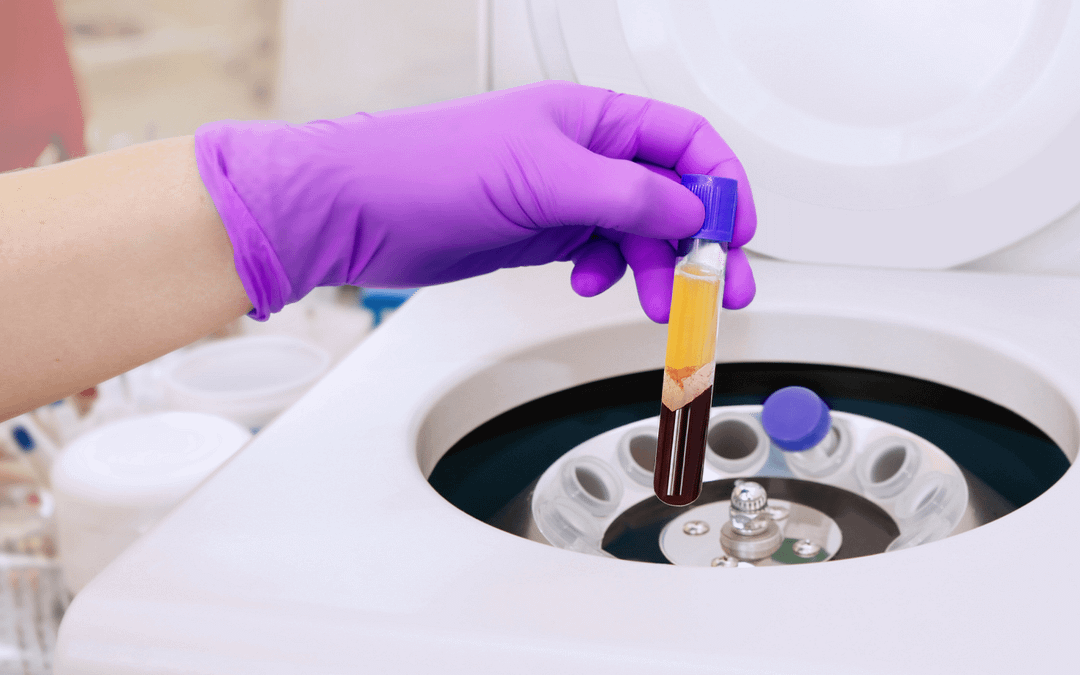 PRP Therapy Preparation