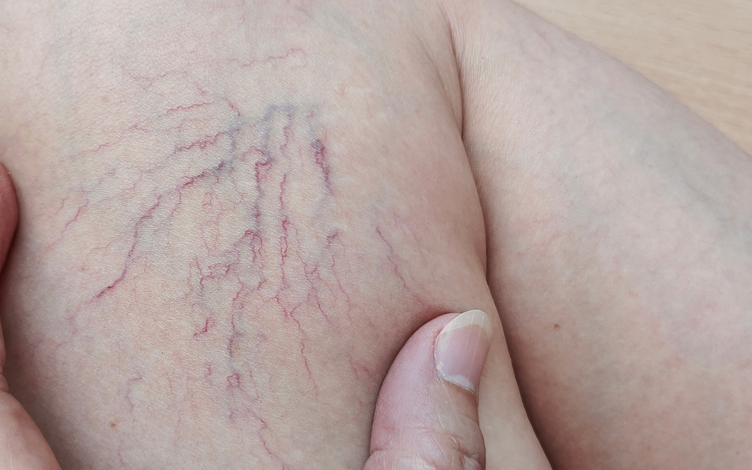 Thermavein Spider Veins