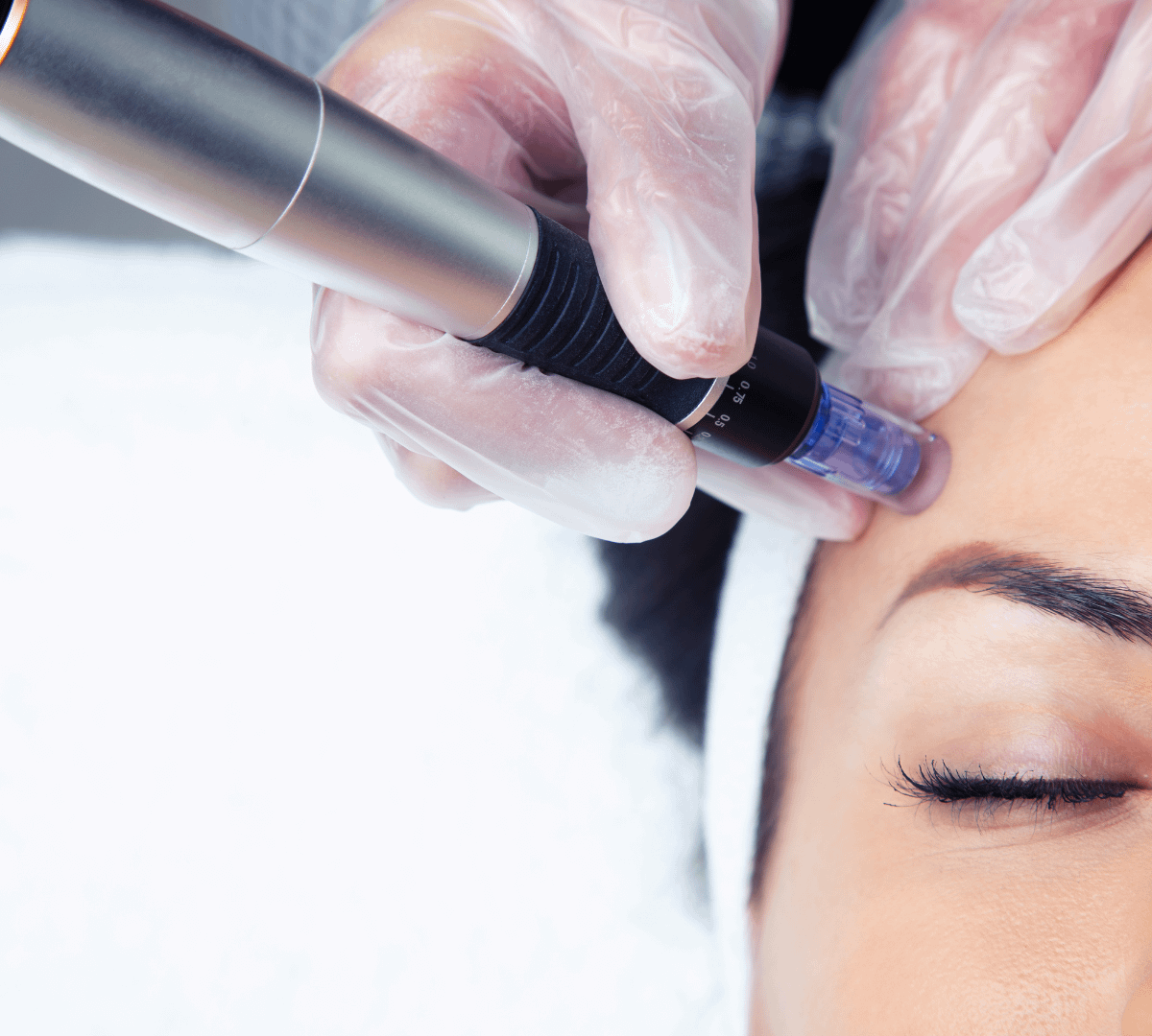microneedling Female patient receiving microneedling treatment