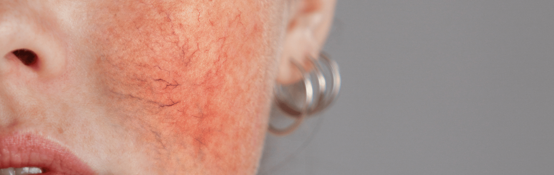 side cheek of female face with red facial varicose veins
