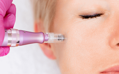 What’s the Hype Surrounding Microneedling?