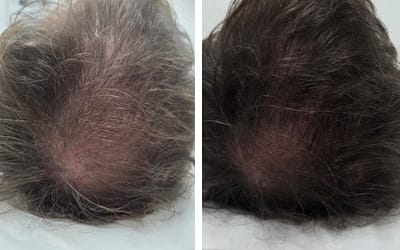 Hair Growth Factors: How They Work and Why Early Treatment Matters